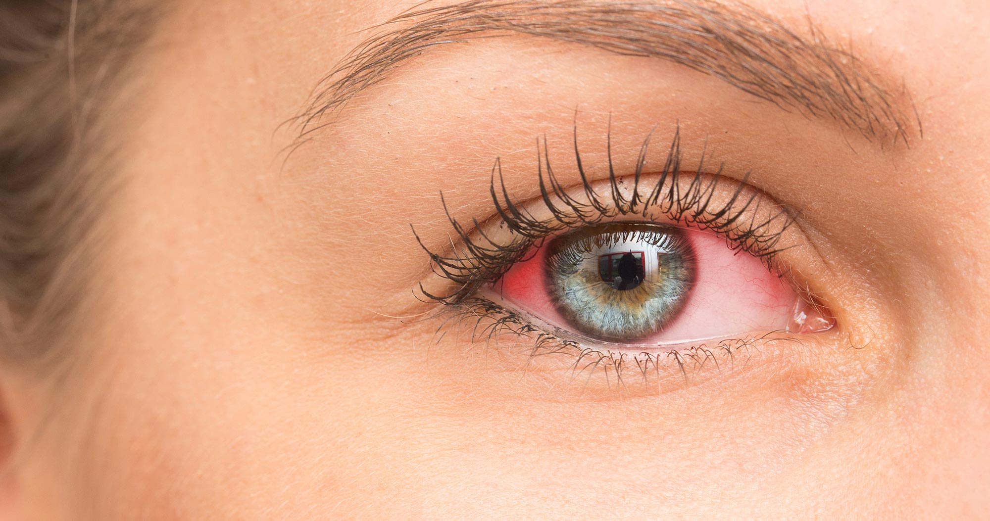 Dry Eye Testing & Treatment Eyes & Optics of Pearland